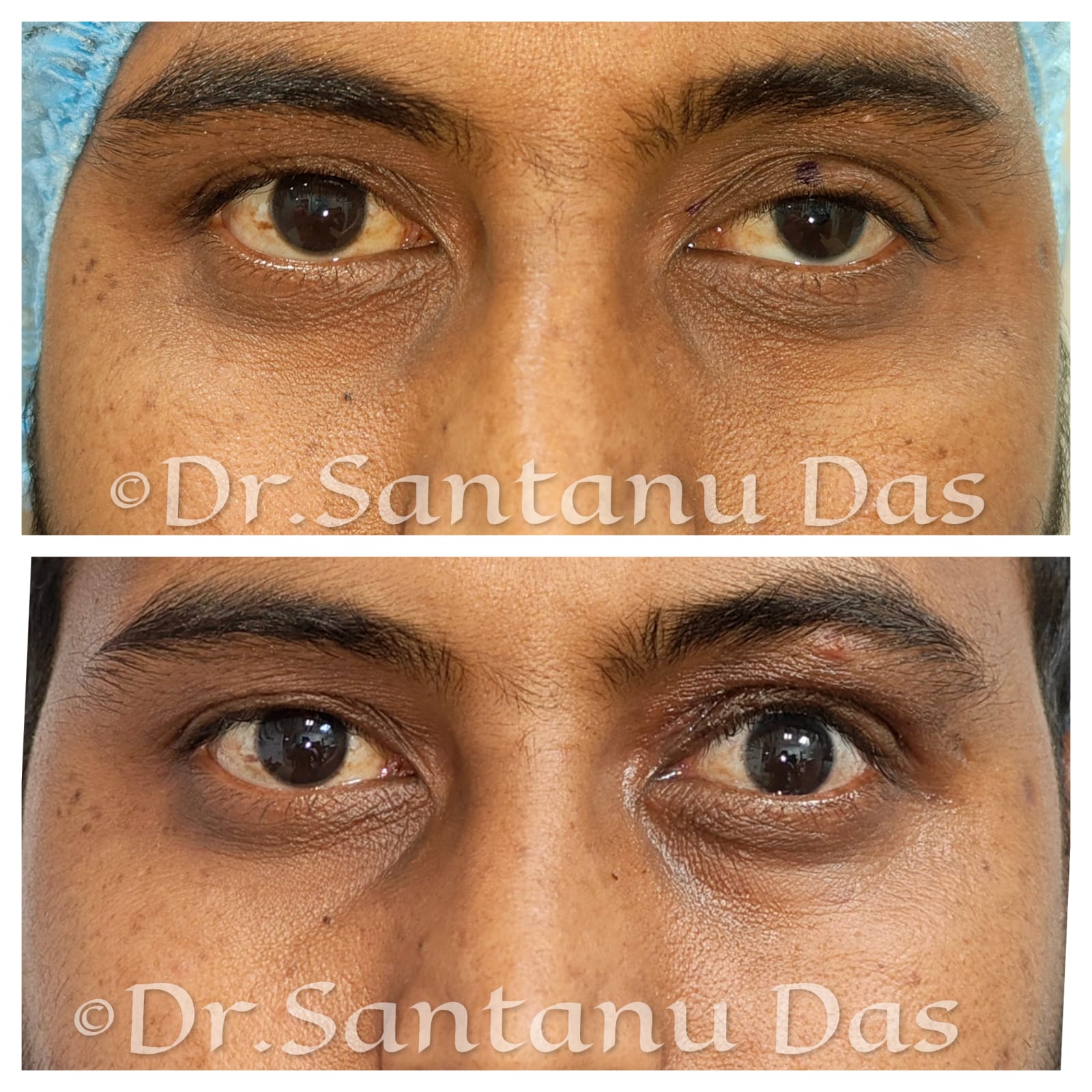 Ptosis Outcome 2
